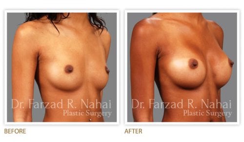Atlanta breast augmentation before-and-after photo #1