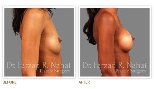 Atlanta breast augmentation before-and-after photo #2