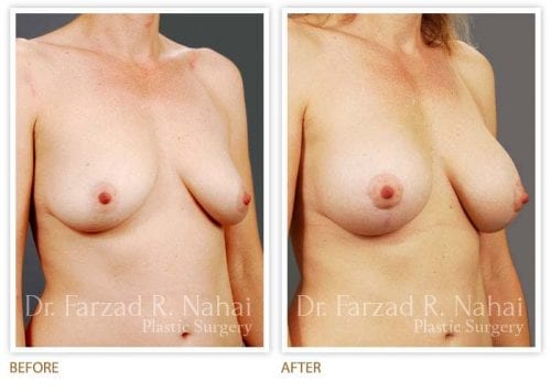 Atlanta breast augmentation before-and-after photo #3