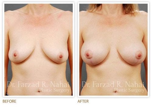 Atlanta breast augmentation before-and-after photo #5