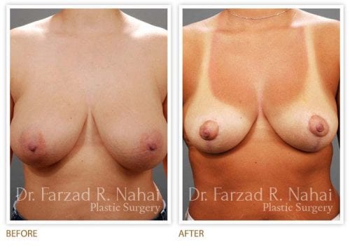 Atlanta breast augmentation before-and-after photo #6