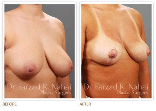 Atlanta breast augmentation before-and-after photo #7