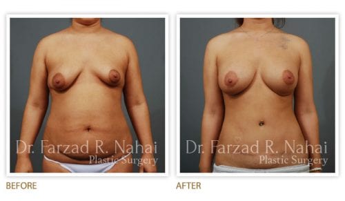 Atlanta breast augmentation before-and-after photo #12