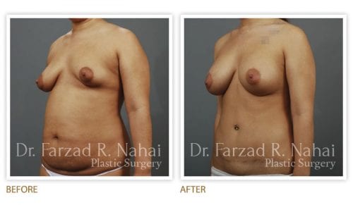 Atlanta breast augmentation before-and-after photo #13