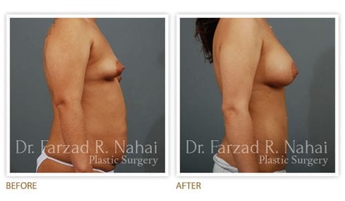 Atlanta breast augmentation before-and-after photo #14