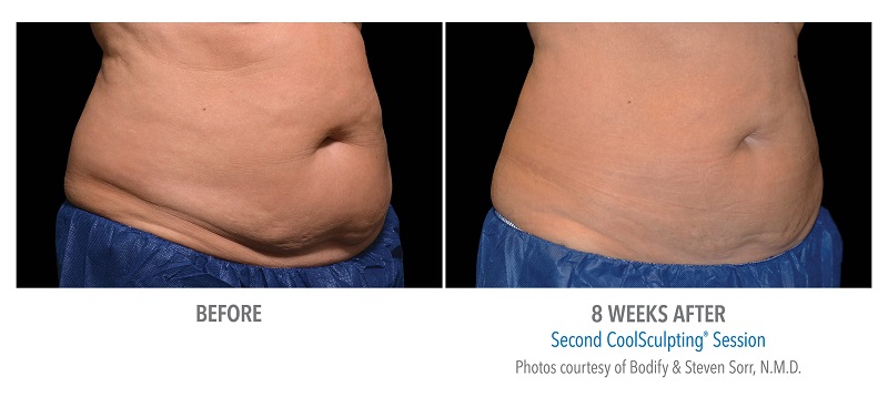 Atlanta CoolSculpting before-and-after photo #1