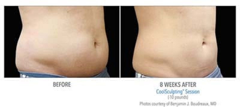 Atlanta CoolSculpting before-and-after photo #3