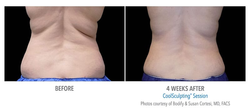 Atlanta CoolSculpting before-and-after photo #4