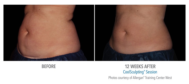 Atlanta CoolSculpting before-and-after photo #5