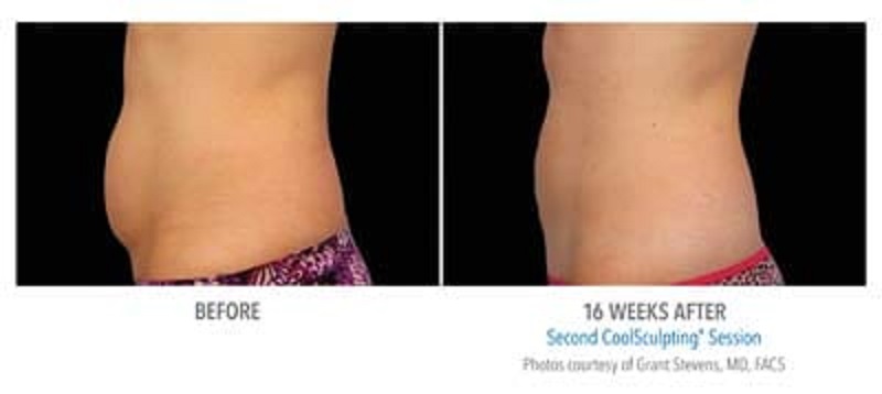 Atlanta CoolSculpting before-and-after photo #6