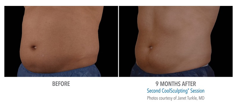 Atlanta CoolSculpting before-and-after photo #7