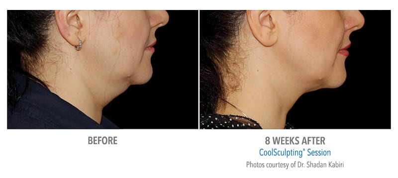 Atlanta CoolSculpting before-and-after photo #8