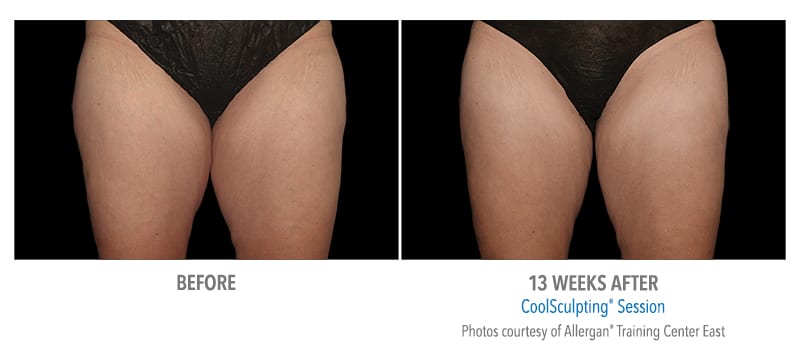 Atlanta CoolSculpting before-and-after photo #13